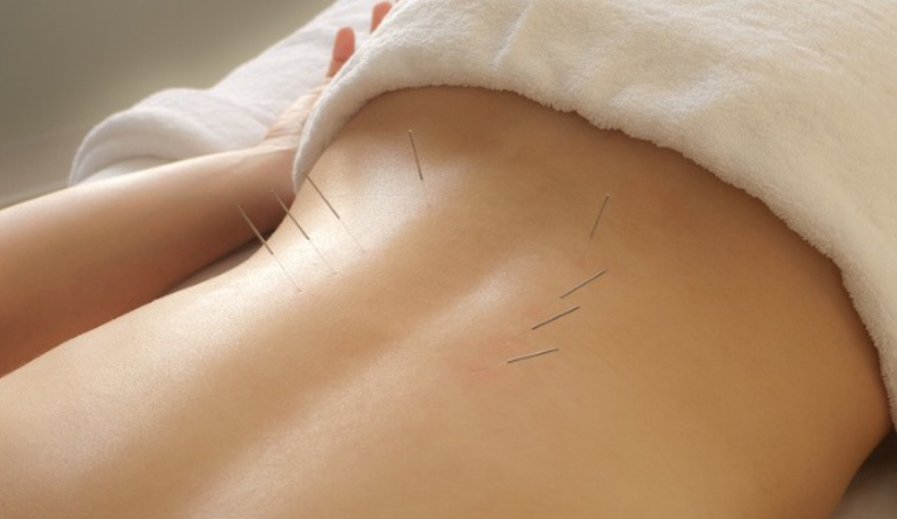 The Role of Acupuncture in Treating Chronic Pain