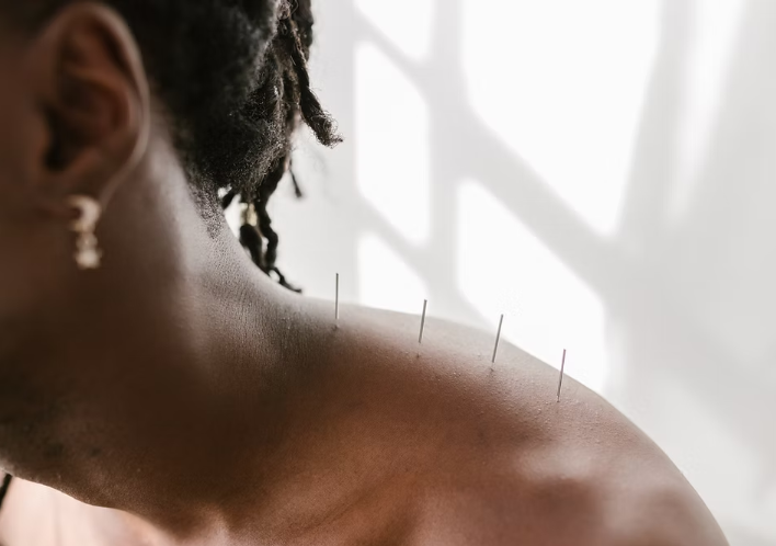 What Is Acupuncture?
